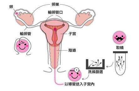 人工周期试管婴儿(解冻移植人工周期用药)