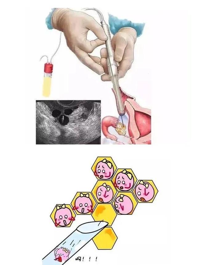 去下试管婴儿(去医院做试管婴儿疼吗)