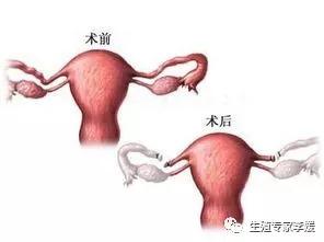 结扎能做试管婴儿(复通术后一定要通水吗)