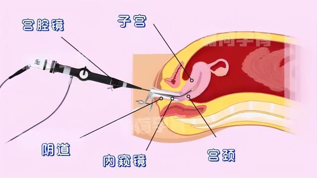 试管婴儿宫腔镜检查 试管婴儿宫腔镜检查