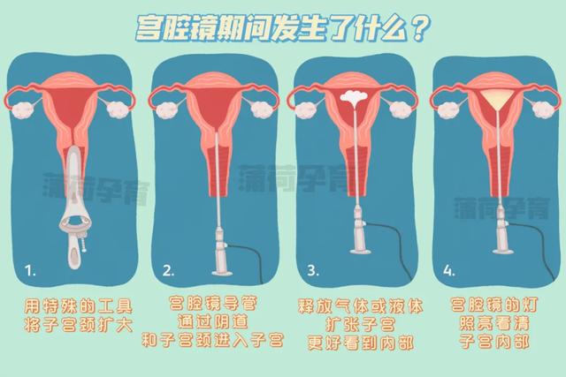 试管婴儿宫腔镜检查 试管婴儿宫腔镜检查