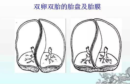 试管婴儿双胞胎第二代三代试管婴儿的优缺点