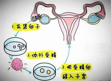 试管婴儿脑瘫 试管婴儿脑瘫