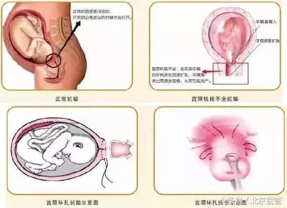大兴试管婴儿 大兴试管婴儿