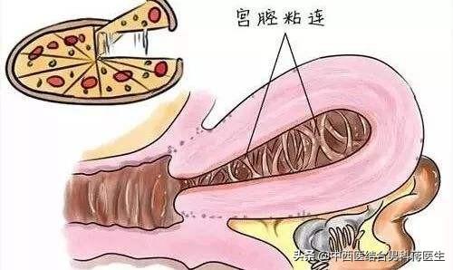子宫内膜与试管婴儿 子宫内膜与试管婴儿