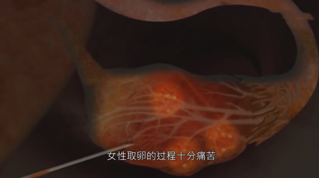 试管婴儿一个 试管婴儿一个