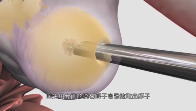 试管婴儿一个 试管婴儿一个