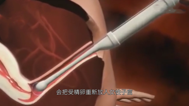 试管婴儿一个 试管婴儿一个