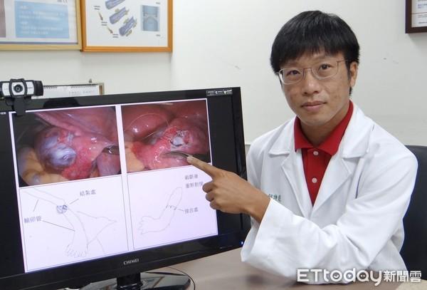 结扎后试管婴儿腹部环扎后能试管移植吗