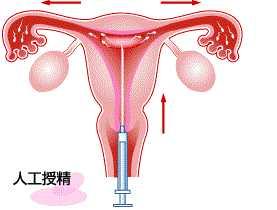 只试管婴儿吗 只试管婴儿吗