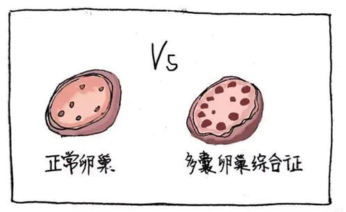 多囊可以做试管婴儿么 多囊可以做试管婴儿么