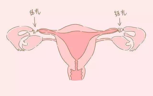 结扎可以试管婴儿吗 结扎可以试管婴儿吗