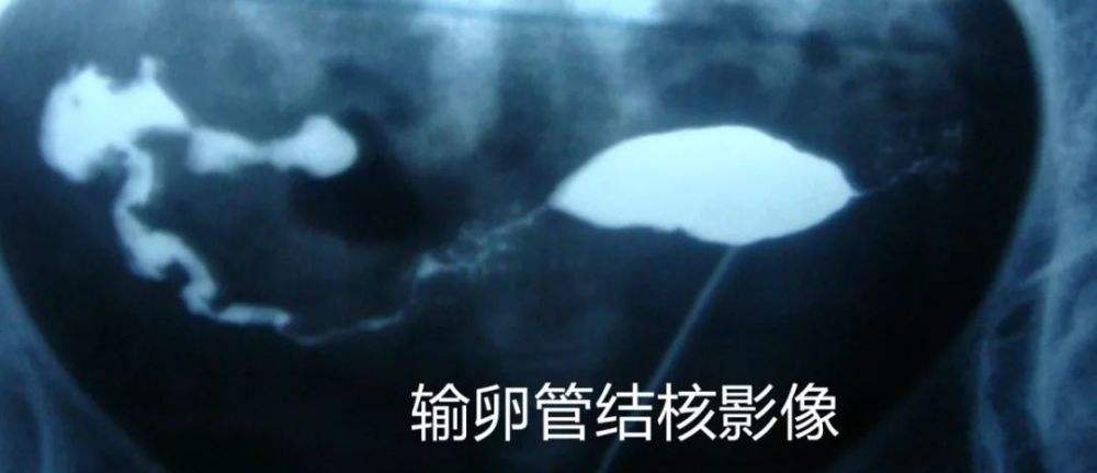 试管婴儿造影试管婴儿还需要做输卵管造影吗