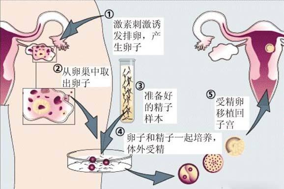 欣试管婴儿 欣试管婴儿