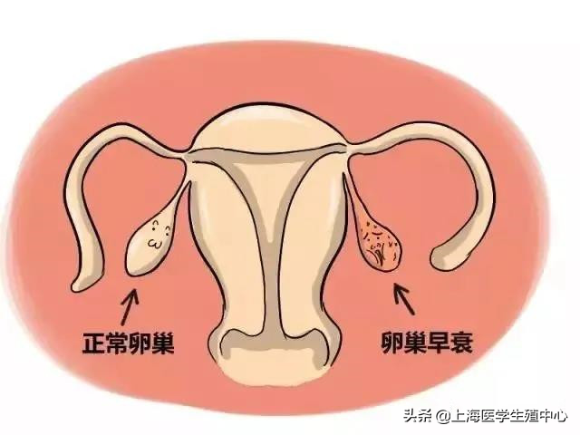 卵巢早衰试管婴儿成功率高吗卵巢早衰能吃来曲唑吗