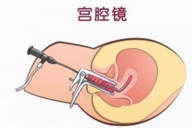 试管婴儿与诊刮 试管婴儿与诊刮