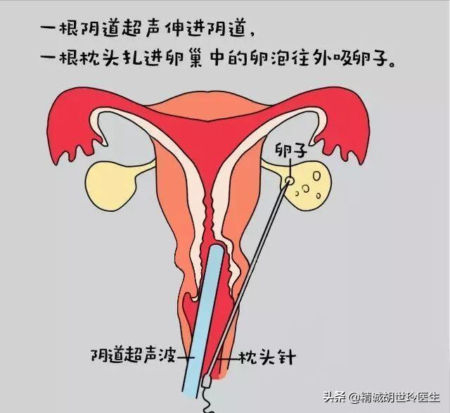 试管婴儿取卵后疼 试管婴儿取卵后疼