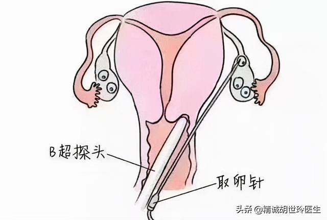 试管婴儿取卵后疼(千万不要做试管婴儿)