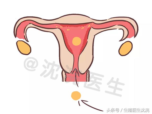 一次试管婴儿 一次试管婴儿