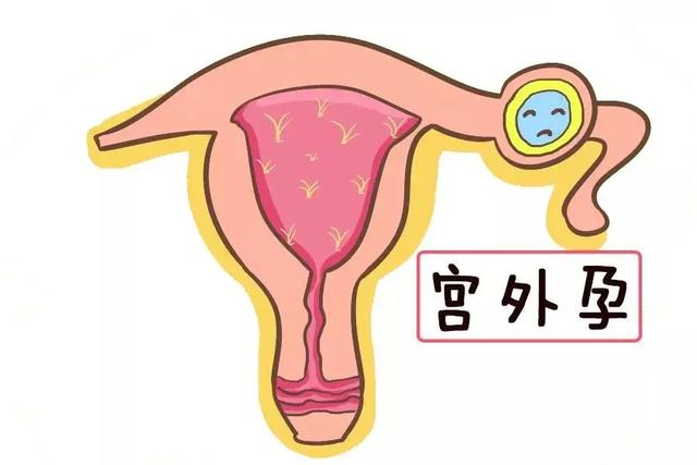 宫外孕试管婴儿几率 宫外孕试管婴儿几率