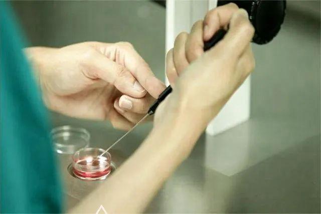 试管婴儿最早世界上第一例试管婴儿诞生