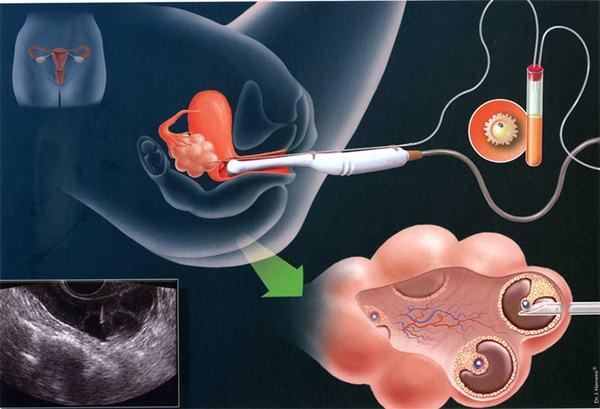 最新试管婴儿成功视频 最新试管婴儿成功视频