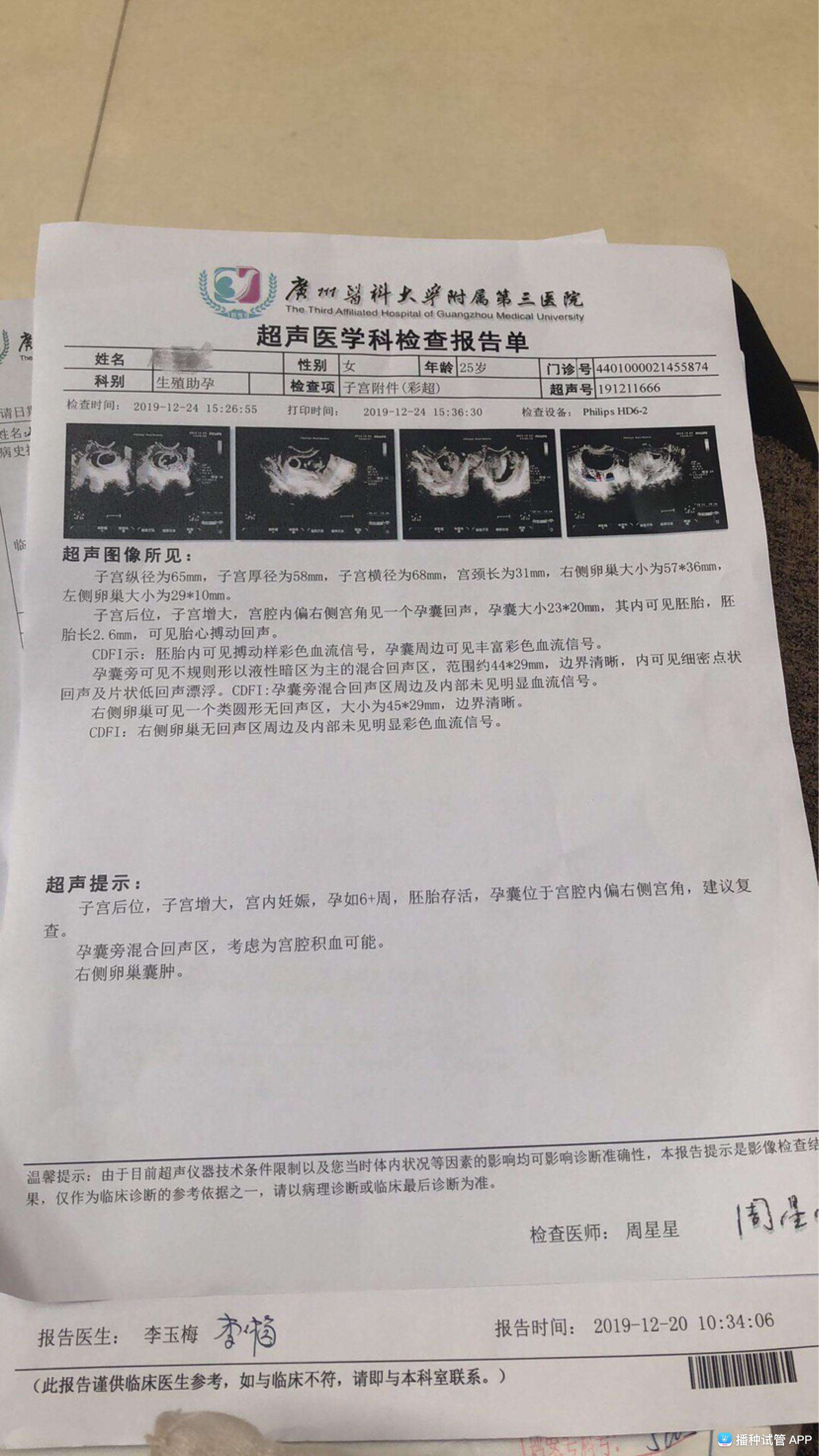 试管婴儿的一超(试管2超后就安全了)