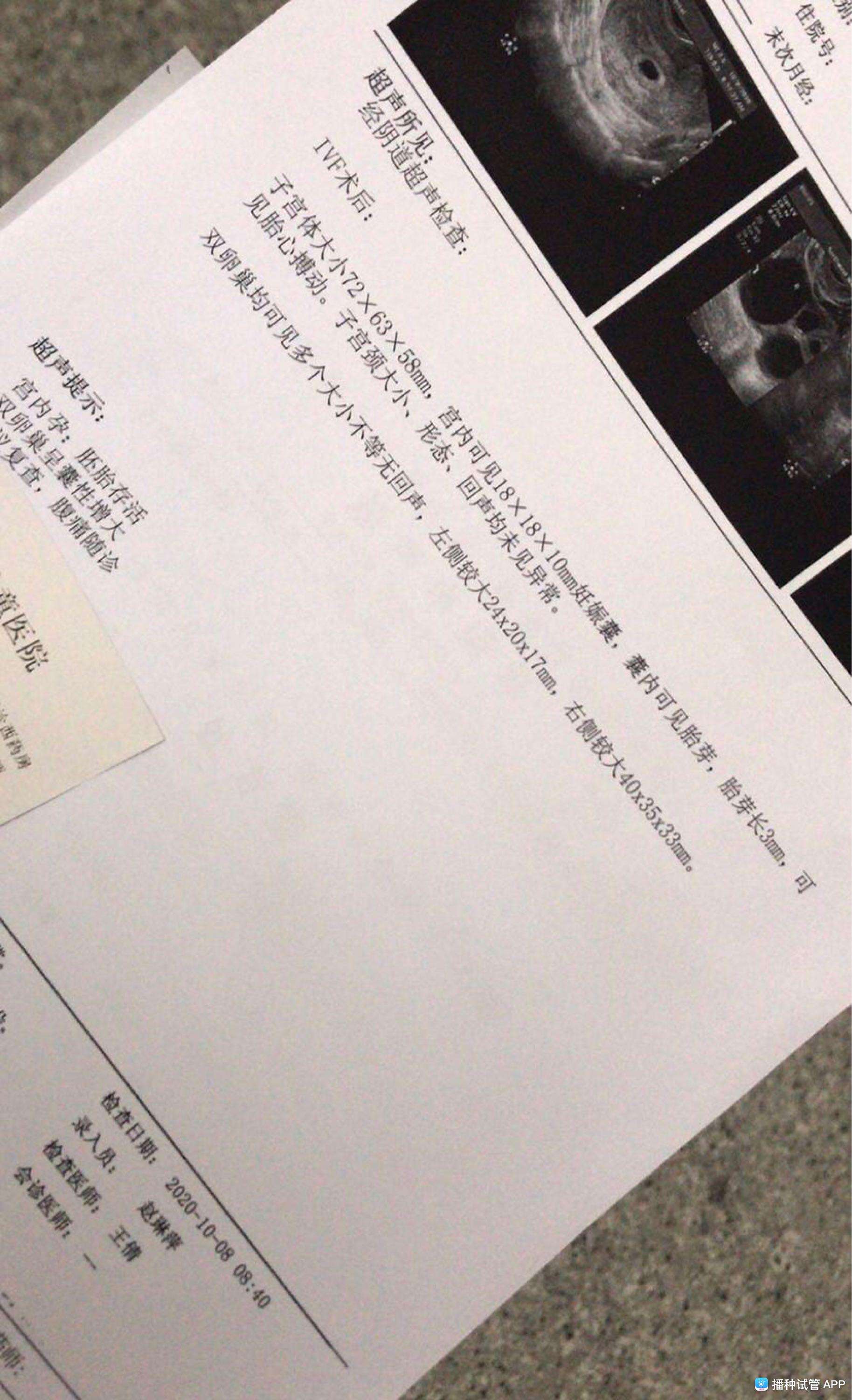 试管婴儿的一超(试管2超后就安全了)
