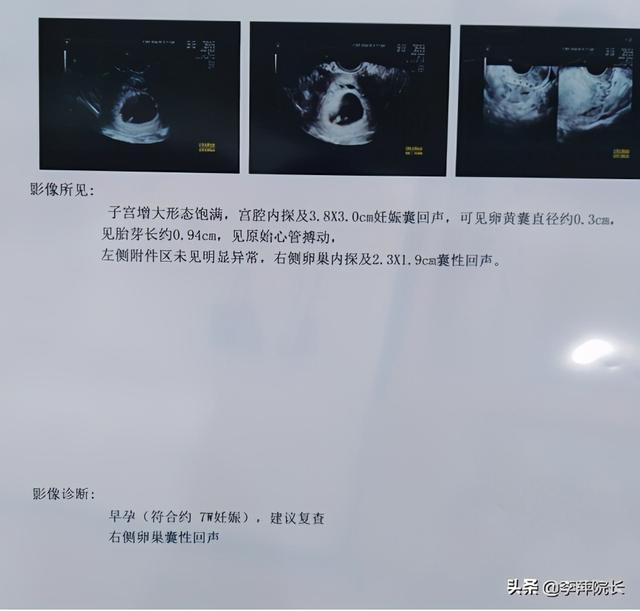 宫外孕能做试管婴儿 宫外孕能做试管婴儿