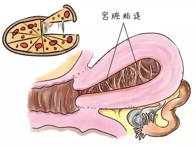 宫腔粘连对试管婴儿 宫腔粘连对试管婴儿