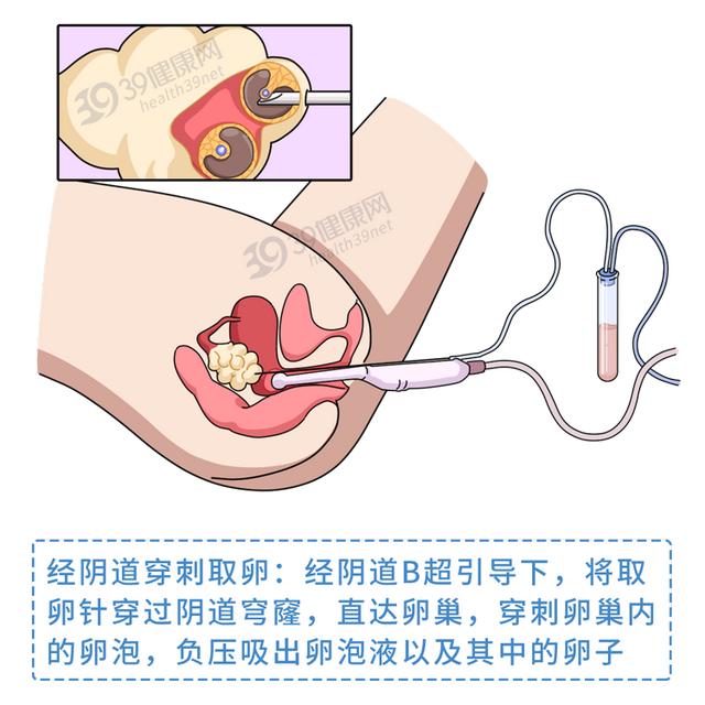 试管婴儿去哪 试管婴儿去哪