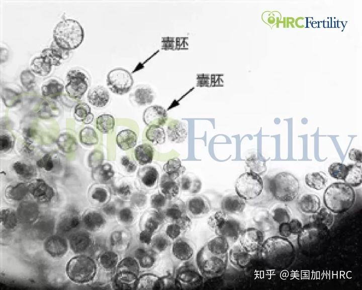 hrc试管婴儿试管婴儿只能活40岁