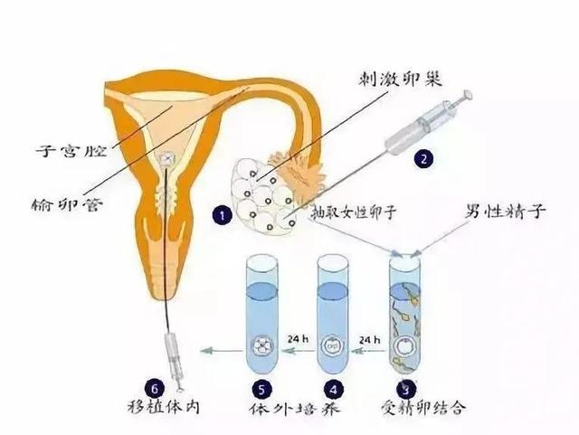 试管婴儿代 试管婴儿代