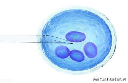 子宫腺肌症与试管婴儿 子宫腺肌症与试管婴儿