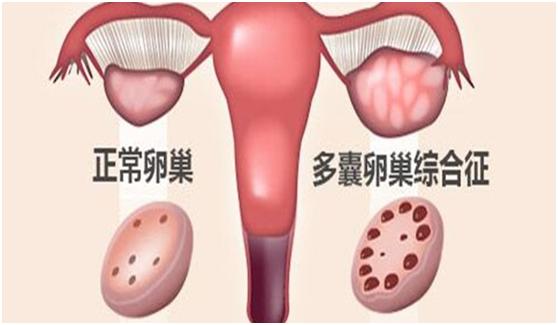 多囊可以做试管婴儿吗(多囊试管婴儿成功率)