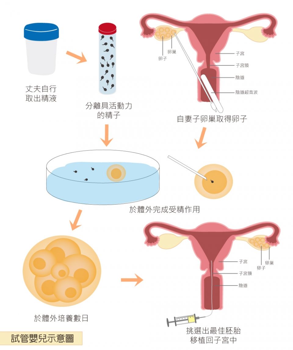 试管婴儿有喜正常人做试管婴儿好吗