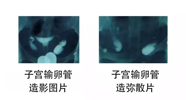 积水能做试管婴儿吗 积水能做试管婴儿吗