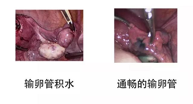 积水能做试管婴儿吗 积水能做试管婴儿吗