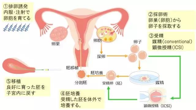 伊朗试管婴儿