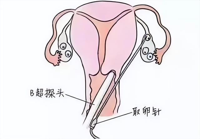 试管婴儿冲洗