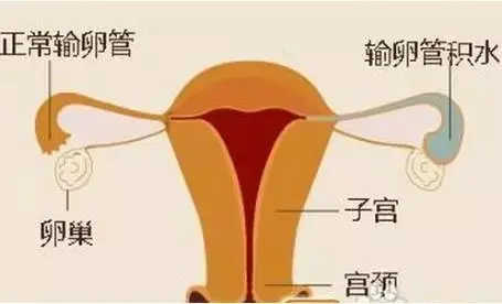 输卵管积水做试管婴儿 输卵管积水做试管婴儿