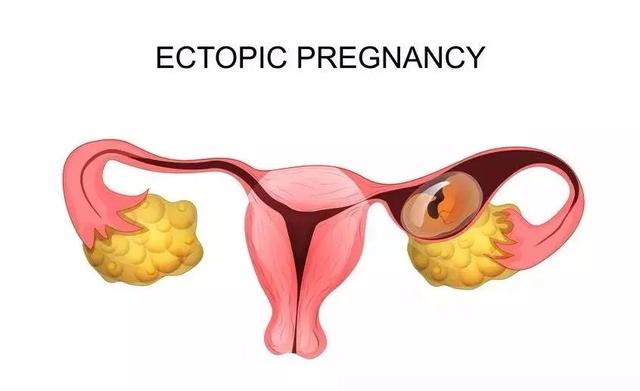 试管婴儿宫外孕几率 试管婴儿宫外孕几率