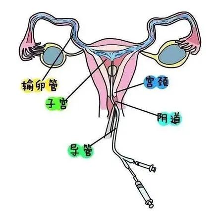 输卵管造影与试管婴儿 输卵管造影与试管婴儿