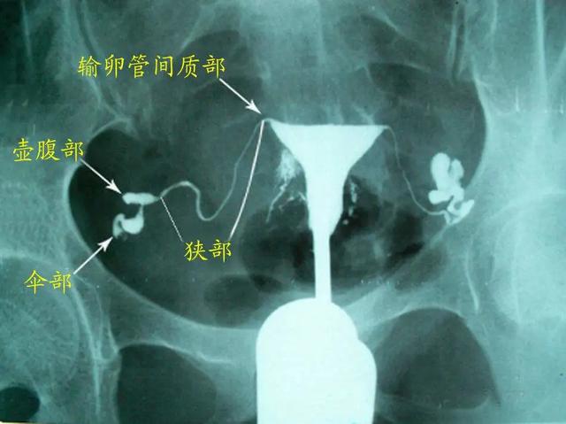 输卵管造影与试管婴儿 输卵管造影与试管婴儿