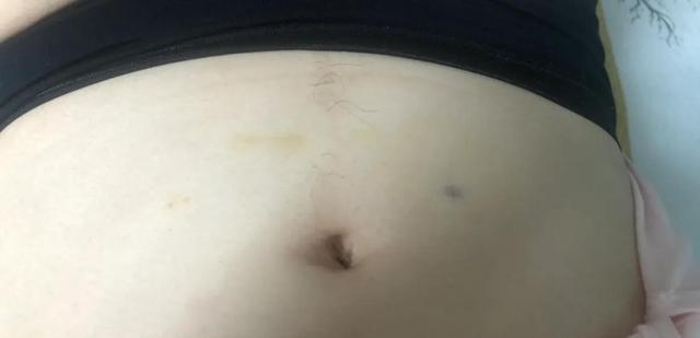 试管婴儿什么是促排试管婴儿收费