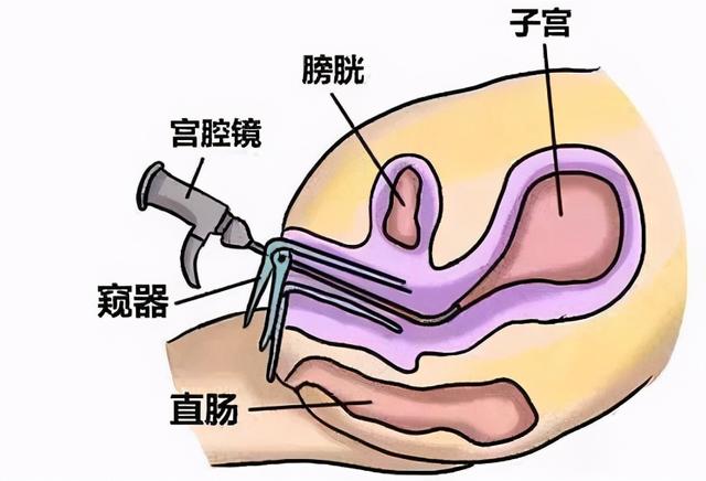 试管婴儿前做宫腔镜(移植前要做宫腔镜吗)