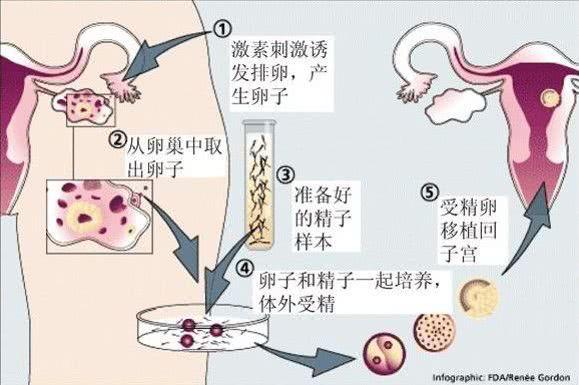 试管婴儿费用表做一次试管婴儿费用