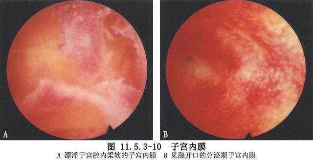 试管婴儿还做宫腔镜吗做试管还要做宫腔镜吗