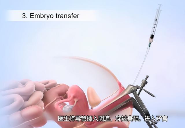 美国试管婴儿费用 美国试管婴儿费用