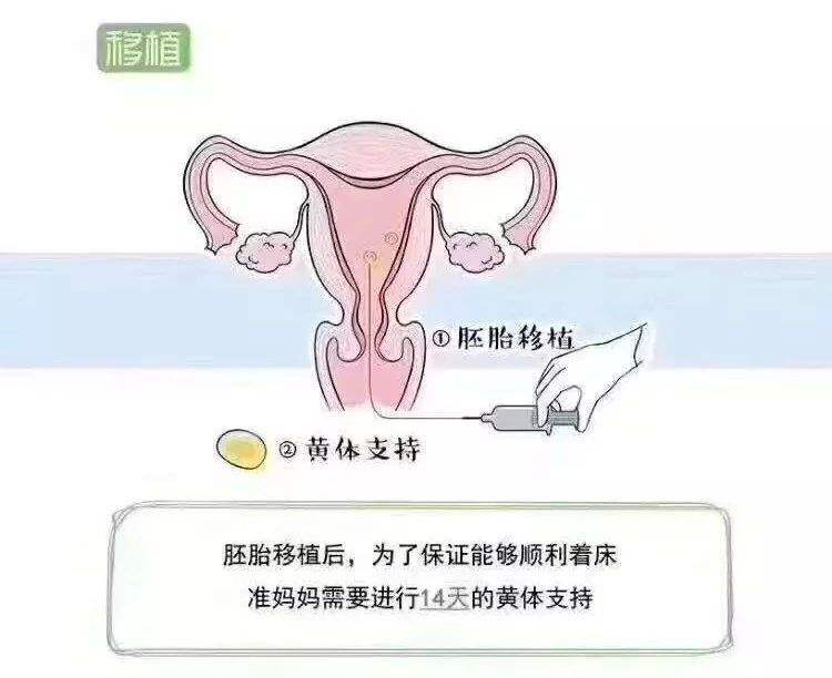 做试管婴儿流产试管婴儿快7个月流产